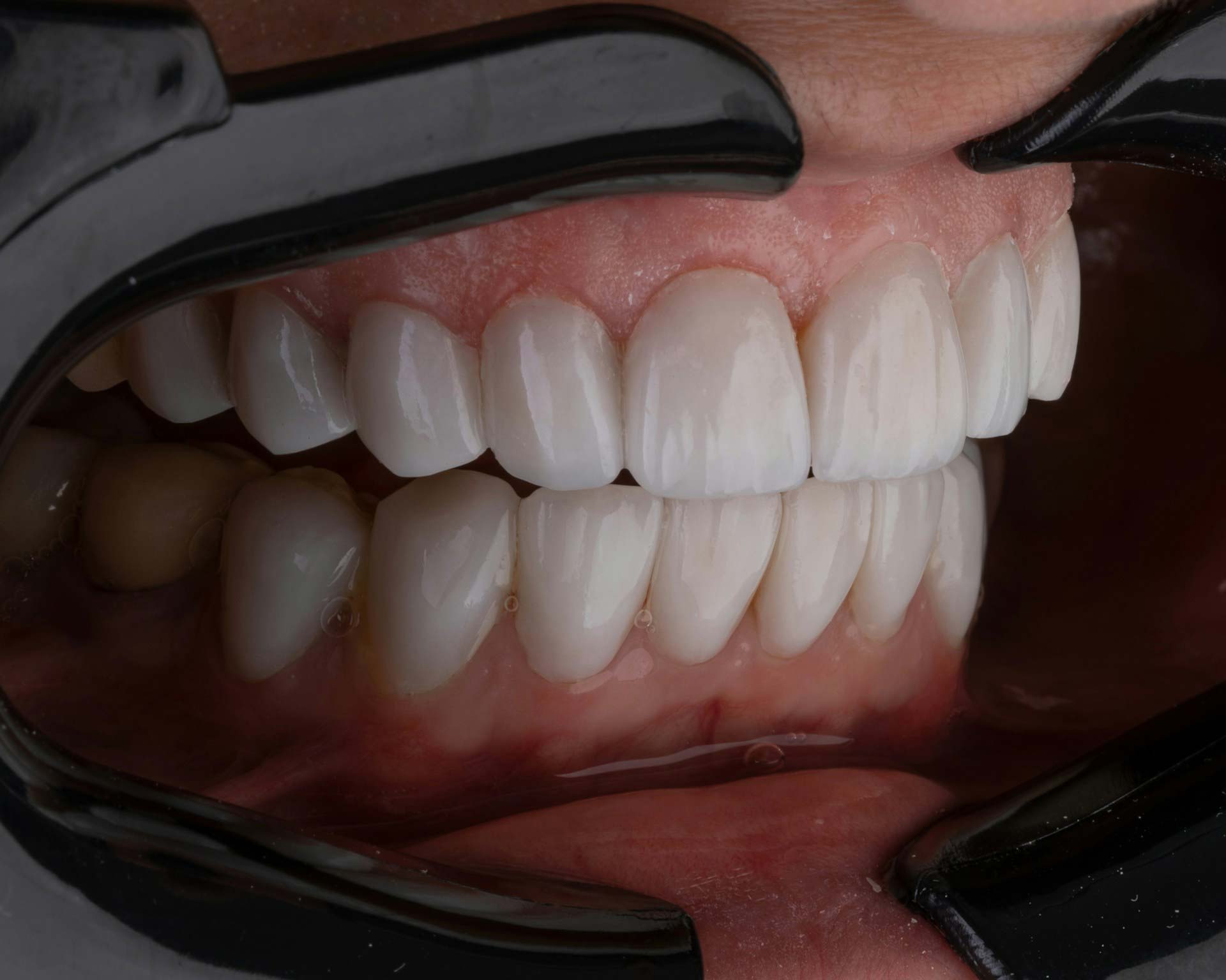 gingivitis