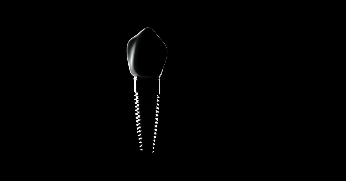 Clínica especialista en implantes dentales en Alcorcón