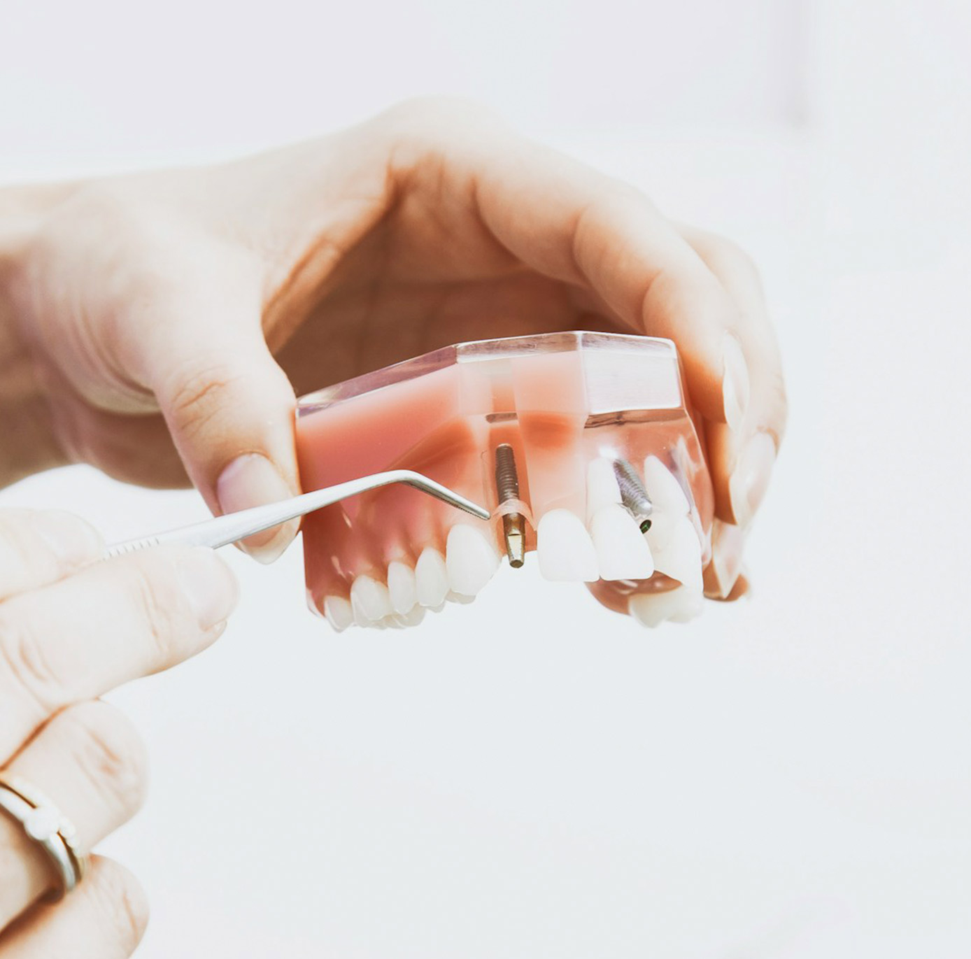 implantes