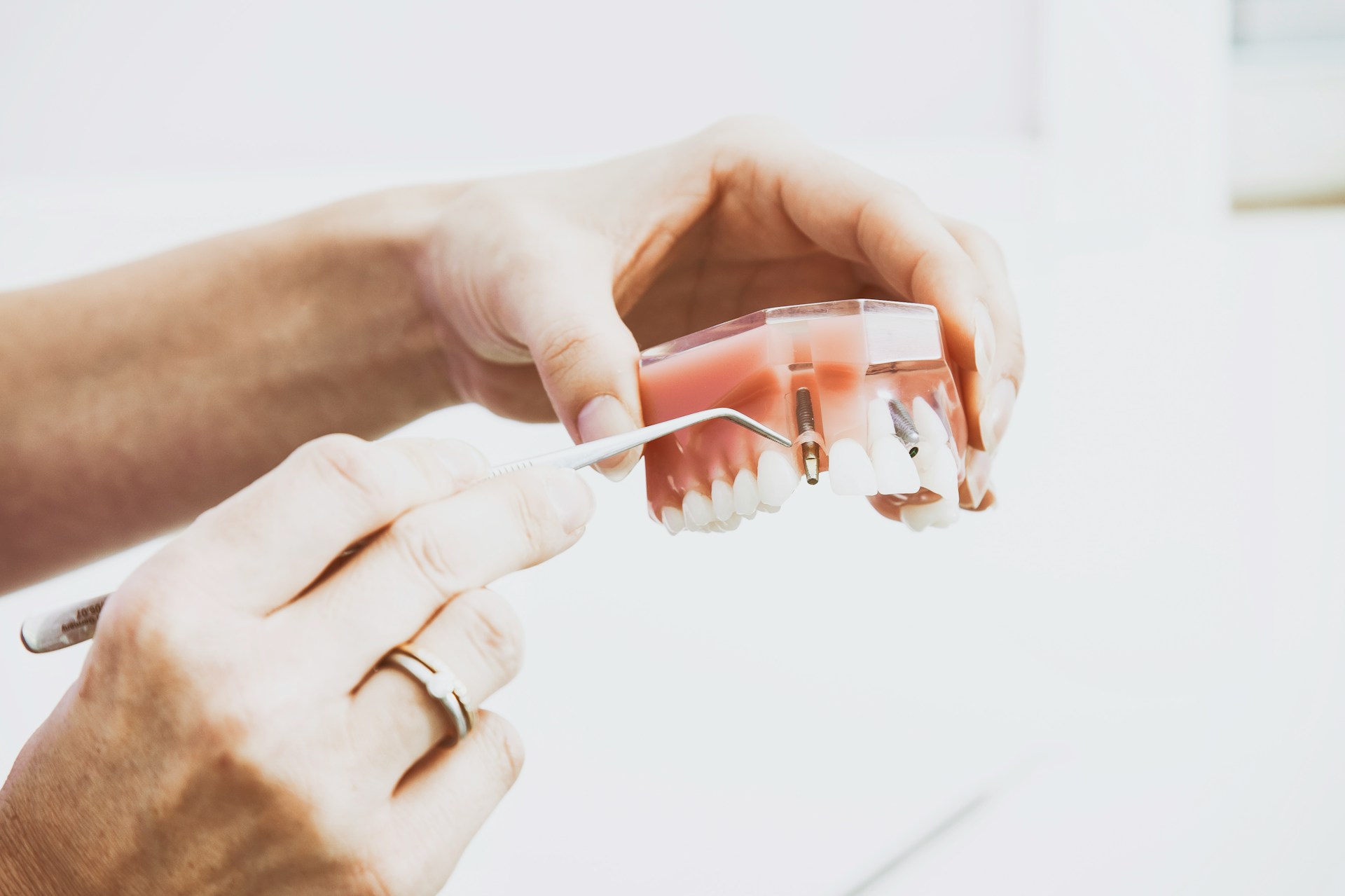 que-es-implante-dental