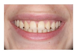 post caso sonrisa gingival