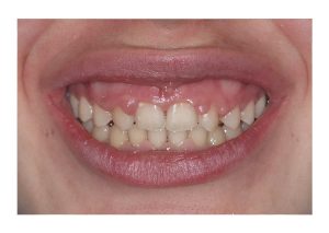 sonrisa gingival