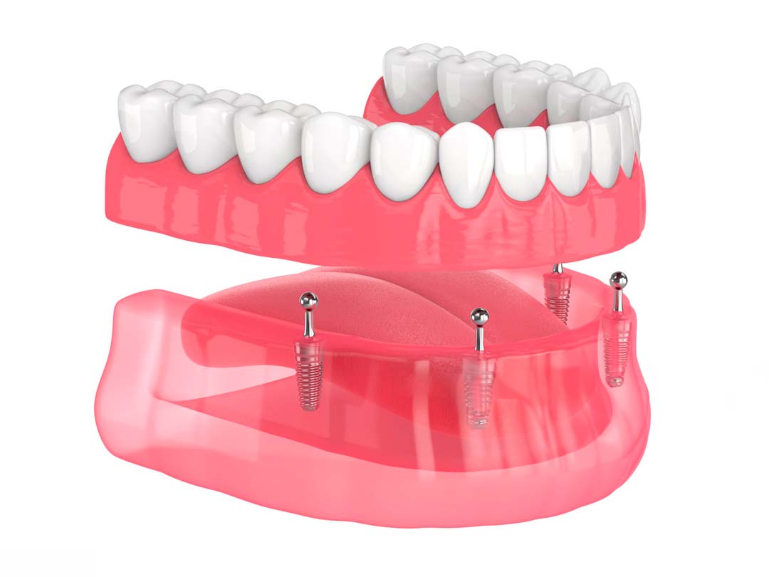 4 implantes