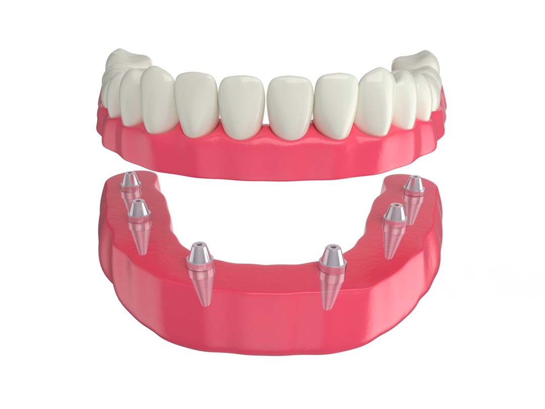 protesis 6 implantes