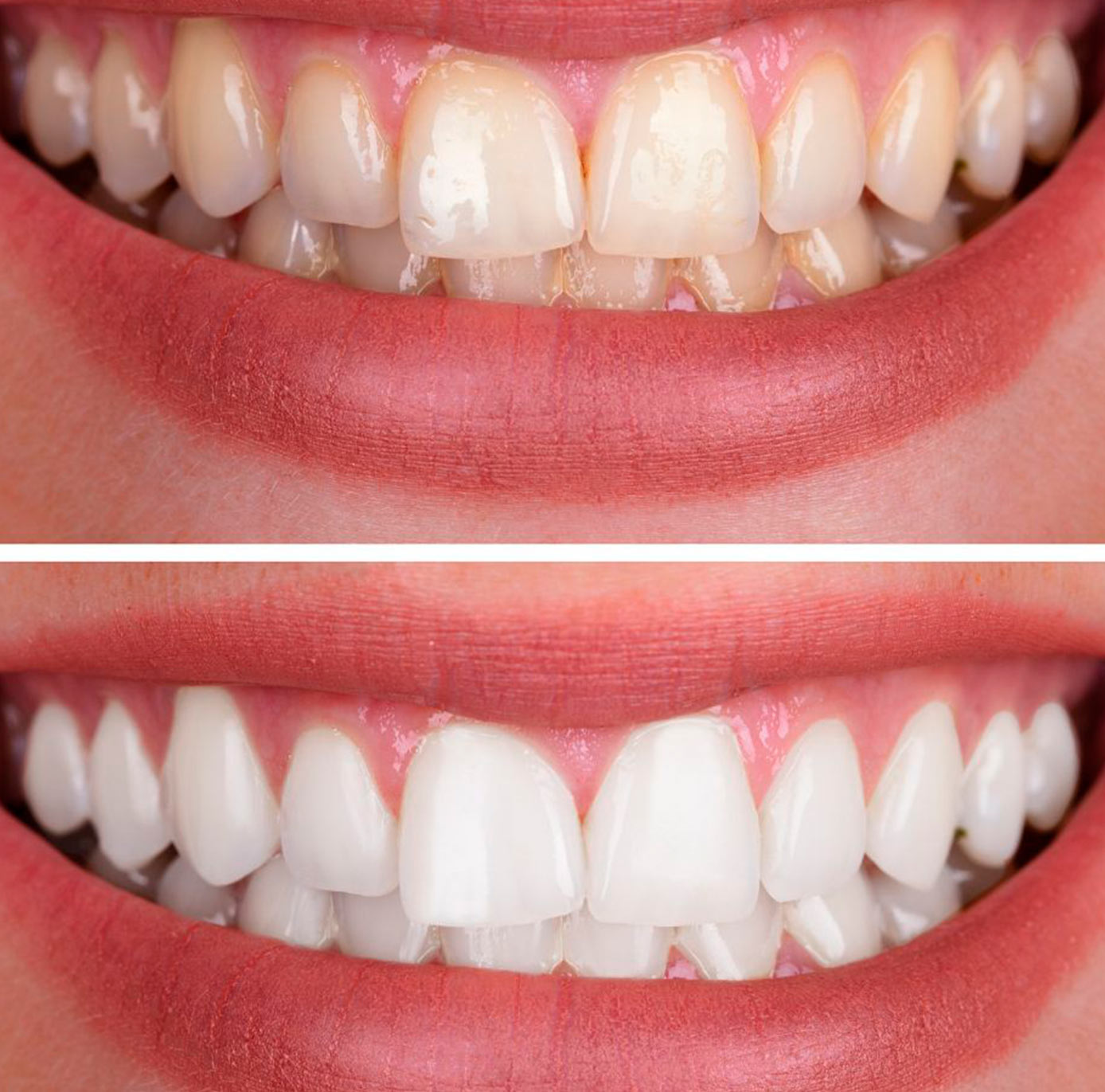 blanqueamiento-dental blanqueamiento