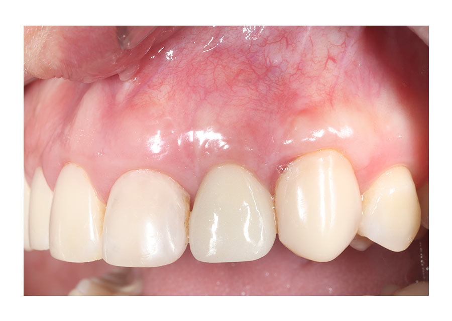 implante inmediato post