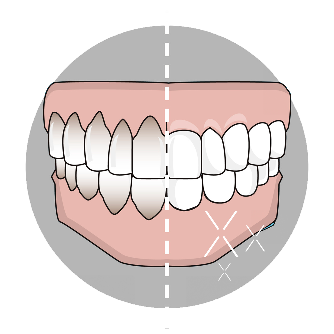encias-retraidas-alcorcon Retraccion encias: Periodoncista en Alcorcón