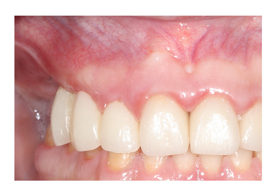 implantes inmediatos