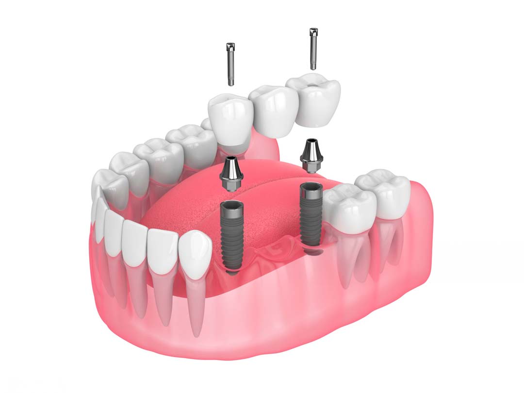 puente implantes