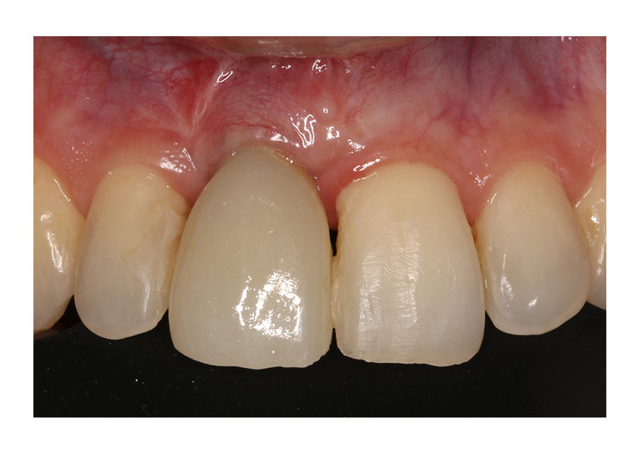 recesión extrema caso post cirugía