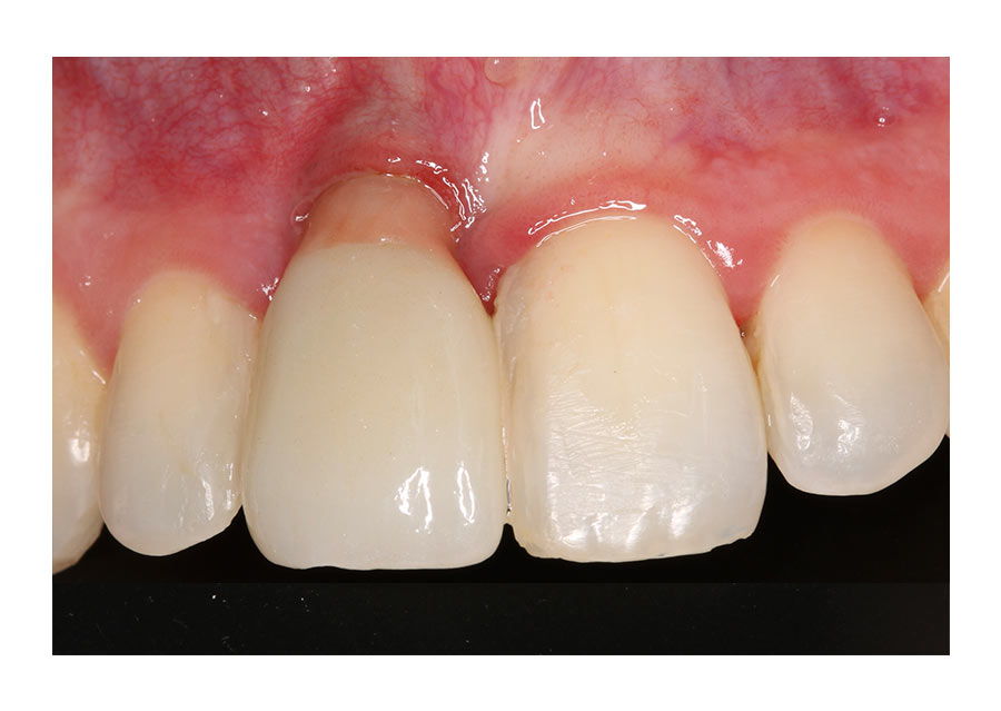 recesión encía caso