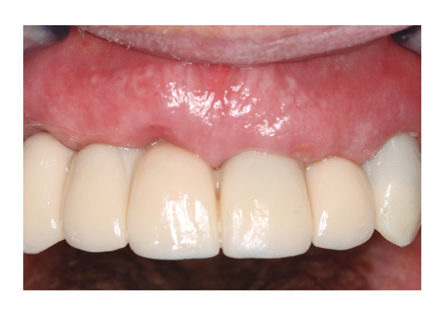 recesión extrema caso post