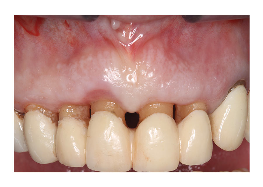 recesión extrema caso
