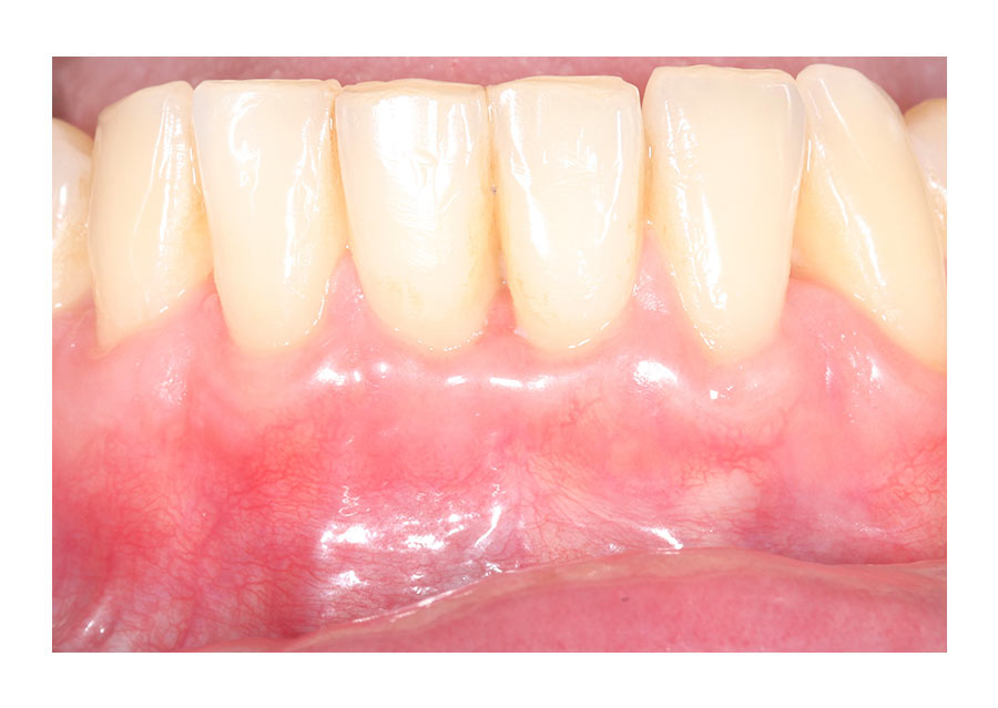 encía retraída post cirugía