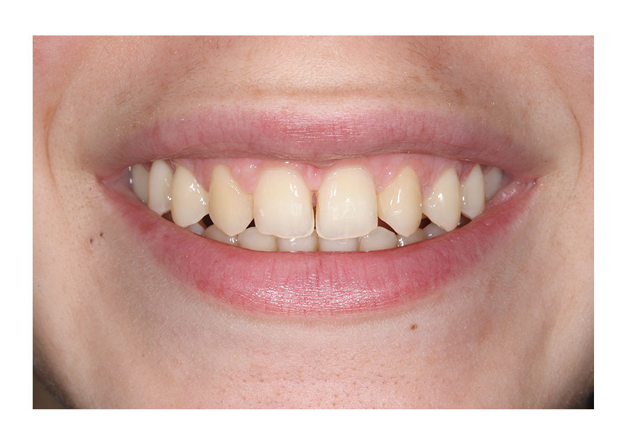 sonrisa gingival