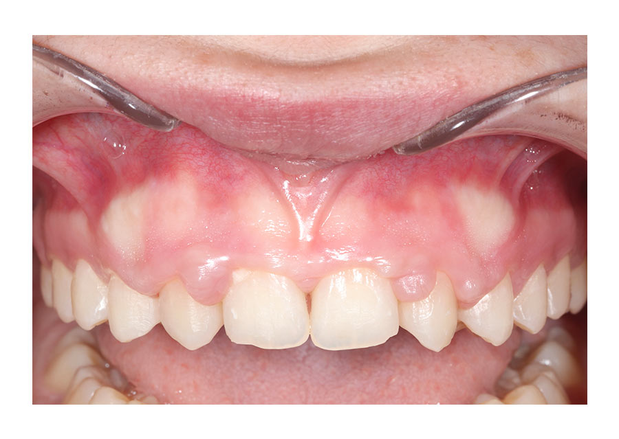 sonrisa gingival pre cirugía