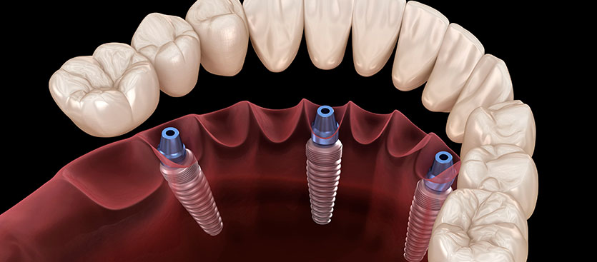 Especialista en Implantes de Carga Inmediata en Alcorcón