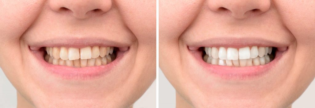 Blanqueamiento dental en Alcorcón con resultados visibles desde el primer día