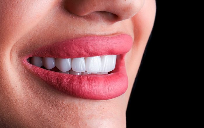 Blanqueamiento dental en Alcorcón