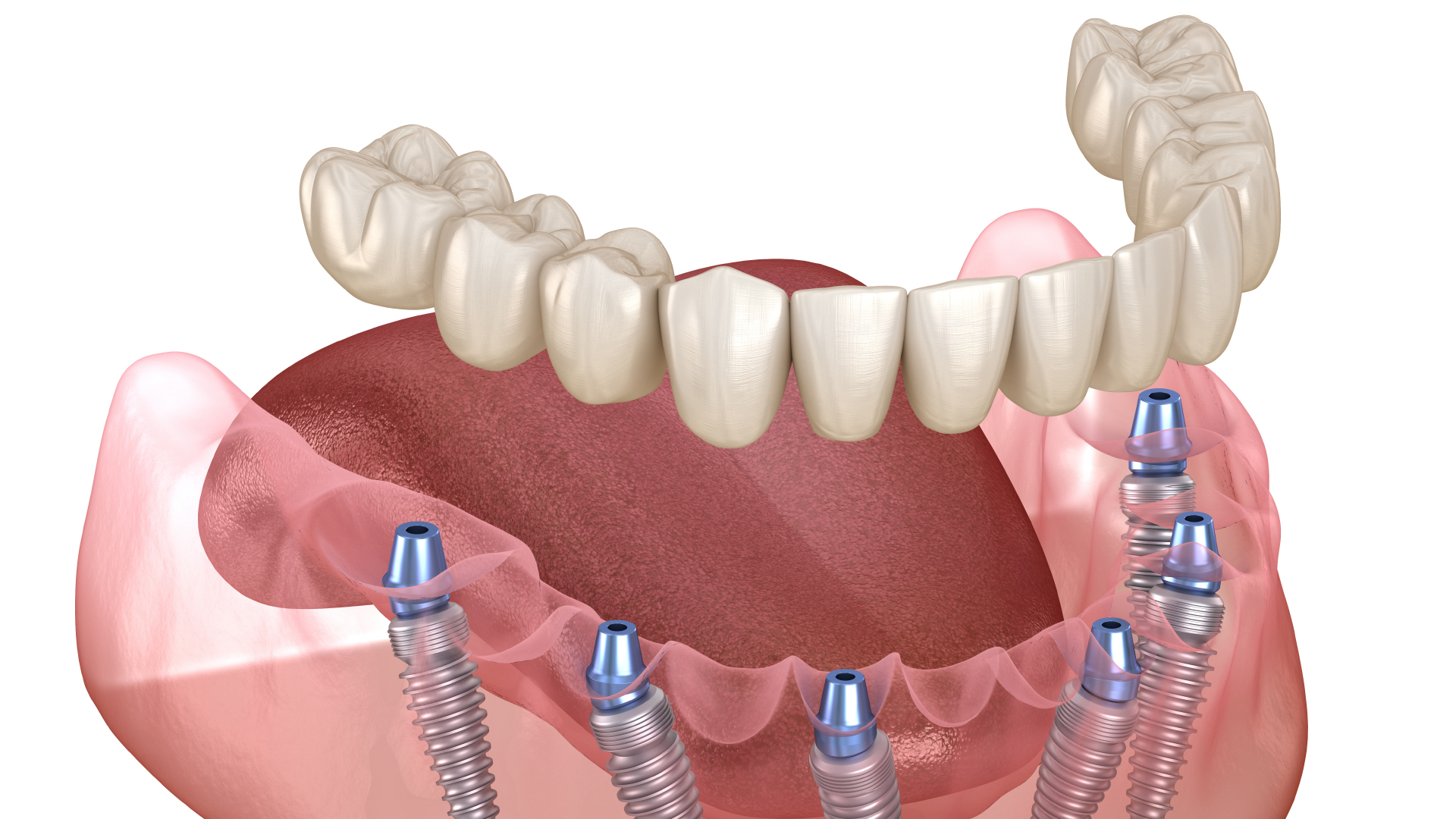 Tipos de prótesis fijas: soluciones avanzadas para recuperar dientes y sonreír con confianza