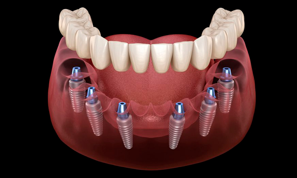 All on Six la mejor opción para recuperar tu sonrisa