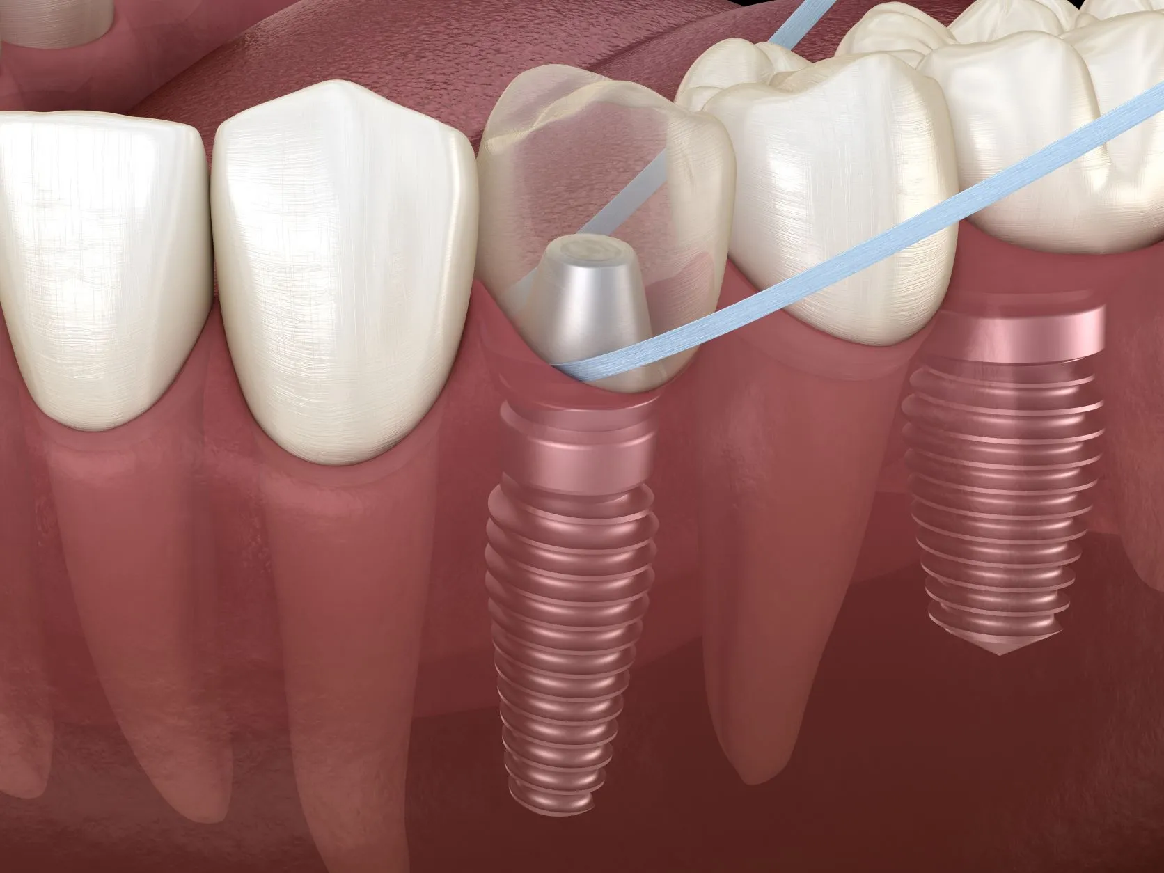 Encías sanas, implantes duraderos: por qué la periodoncia es la base del éxito de cualquier tratamiento dental